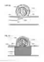 Fig. 04 - Balloon assisted occlusion of aneurysms