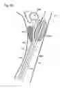 Fig. 06 - Balloon assisted occlusion of aneurysms