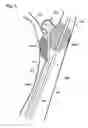 Fig. 07 - Balloon assisted occlusion of aneurysms