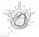 Fig. 01 - APPARATUS UTILIZING A GUIDE WIRE TO MANEUVER HEATING ELEMENT AND PROBE FOR TREATING DAMAGED SPINAL DISCS