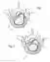 Fig. 02 - APPARATUS UTILIZING A GUIDE WIRE TO MANEUVER HEATING ELEMENT AND PROBE FOR TREATING DAMAGED SPINAL DISCS