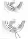 Fig. 02 - Surgical instrument