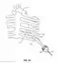 Fig. 08 - Method and apparatus for transapical access and closure