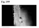 Fig. 255 - Adhesive compounds and methods use for hernia repair