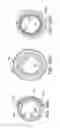 Fig. 45 - Rotational atherectomy device with distal protection capability and method of use