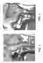 Fig. 02 - Craniospinal fusion method and apparatus