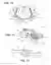 Fig. 06 - Craniospinal fusion method and apparatus