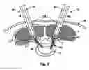 Fig. 07 - Minimally invasive retraction device having removable blades