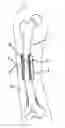 Fig. 01 - Bone regeneration device for bones, and method of use