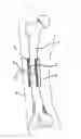 Fig. 02 - Bone regeneration device for bones, and method of use