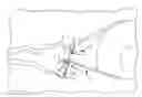 Fig. 01 - Reliably retained shape memory ophthalmological implants
