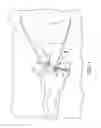 Fig. 02 - Reliably retained shape memory ophthalmological implants