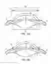 Fig. 02 - SYSTEM AND DEVICE FOR CORRECTING HYPEROPIA, MYOPIA AND PRESBYOPIA