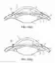 Fig. 09 - SYSTEM AND DEVICE FOR CORRECTING HYPEROPIA, MYOPIA AND PRESBYOPIA