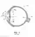 Fig. 02 - ACCOMMODATING INTRAOCULAR LENS SYSTEM INCLUDING A BAG