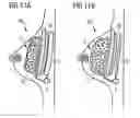 Fig. 16 - Breast implant system
