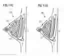 Fig. 17 - Breast implant system