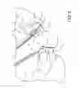 Fig. 06 - Zipper arrangement with funnel grip