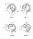 Fig. 04 - Lost motion cam actuating device