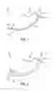 Fig. 02 - NASAL AIRWAY MANAGEMENT DEVICE