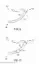 Fig. 06 - NASAL AIRWAY MANAGEMENT DEVICE