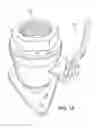 Fig. 02 - Tight space, inside boat thruhole fitting clearing