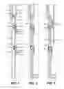Fig. 02 - Multi-position valve for fracturing and sand control and associated completion methods
