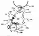 Fig. 01 - Ring Keeper System and Method