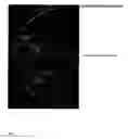 Fig. 06 - Breast tomosynthesis with display of highlighted suspected calcifications