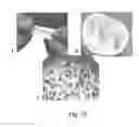 Fig. 11 - Compositions and Methods of Using Living and Non-Living Bioactive Devices with Components Derived From Self-Renewing Colony Forming Cells Cultured and Expanded In Vitro