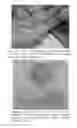 Fig. 64 - Compositions and Methods of Using Living and Non-Living Bioactive Devices with Components Derived From Self-Renewing Colony Forming Cells Cultured and Expanded In Vitro