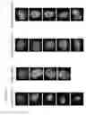 Fig. 20 - Bone void fillers