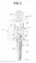 Fig. 02 - Dental implant
