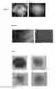 Fig. 02 - Generation of neural stem cells from undifferentiated human embryonic stem cells