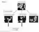 Fig. 04 - Generation of neural stem cells from undifferentiated human embryonic stem cells