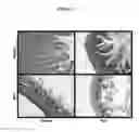 Fig. 05 - COMPOSITIONS AND METHODS FOR TREATING NECROTIZING ENTEROCOLITIS