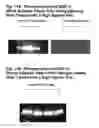 Fig. 12 - Methods of Treating Lipomas and Liposarcomas