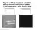 Fig. 14 - Methods of Treating Lipomas and Liposarcomas