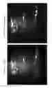 Fig. 15 - Methods of Treating Lipomas and Liposarcomas
