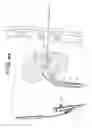 Fig. 07 - Percutaneous renal access system