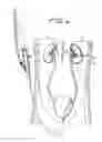 Fig. 08 - Percutaneous renal access system