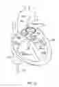 Fig. 15 - Methods of advancing a cannula system into a body