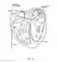 Fig. 16 - Methods of advancing a cannula system into a body