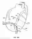 Fig. 14 - Stabilizer for robotic beating-heart surgery