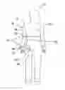 Fig. 01 - Arm brace