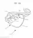 Fig. 03 - Apparatus, composition, and method to treat amblyopia