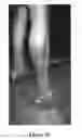Fig. 09 - Ultrasonic dispersion of compositions in tissue