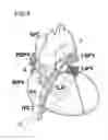 Fig. 05 - BALLOON CATHETER SYSTEM