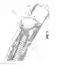 Fig. 04 - Flexible debulking catheters with imaging and methods of use and manufacture