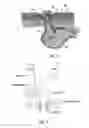 Fig. 06 - Percutaneous implant and ostomy method